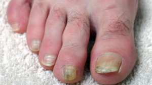 Treat unsightly toenail fungus from home with these remedies